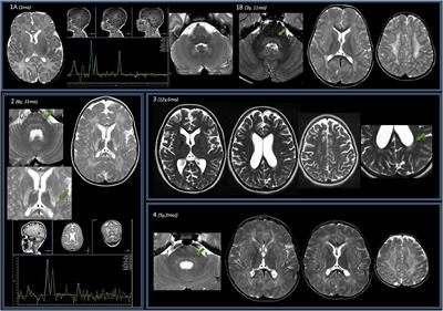 Multicentric Retrospective Evaluation of Five Classic Infantile Pompe Disease Subjects Under Enzyme Replacement Therapy With Early Infratentorial Involvement